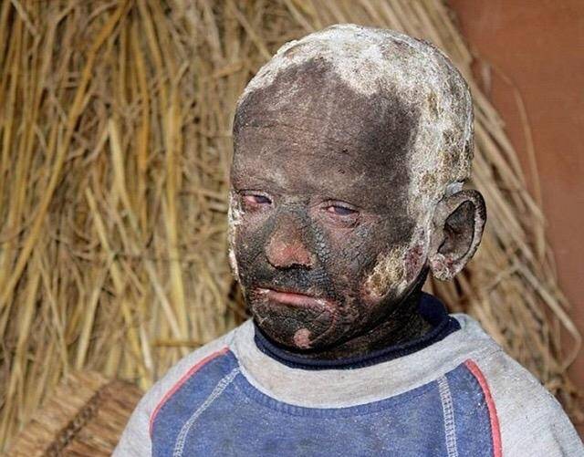 印度男孩即将变成石头世界罕见怪病