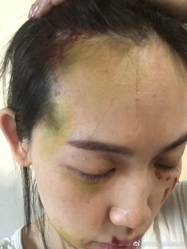 马蓉受伤照细节曝光多处淤青脸部毁容