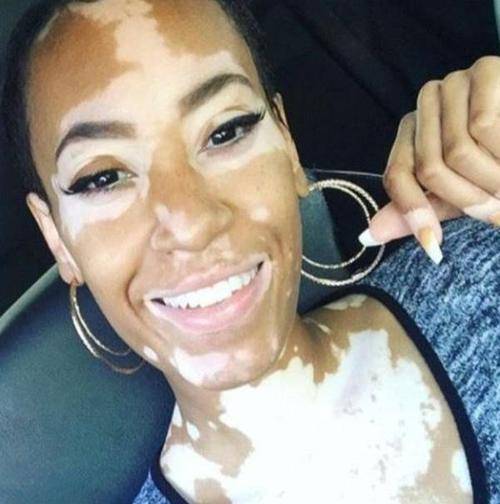 黑人女全身大部分患白癜风最后竟被选中当模特