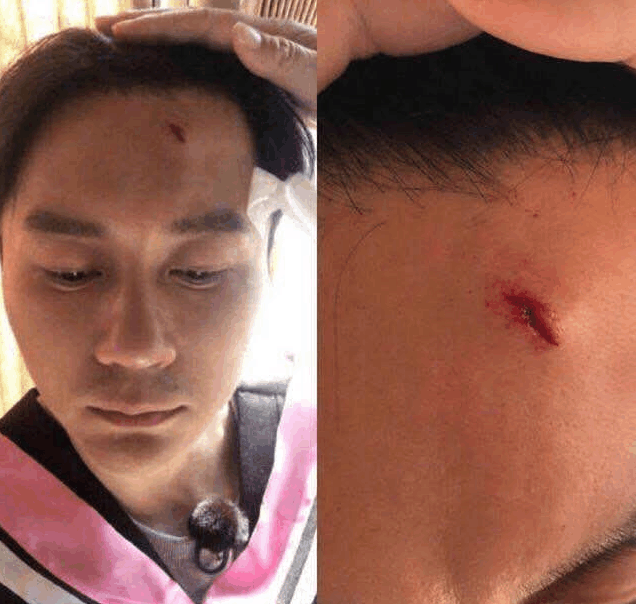 性的出现意外,就像李晨,他们在游戏环节中因为一个失误而导致额头出血